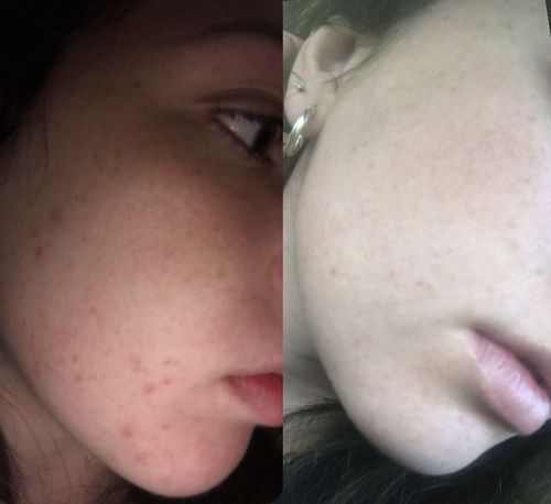 Customer before and after with Clear Envy - Emma G.