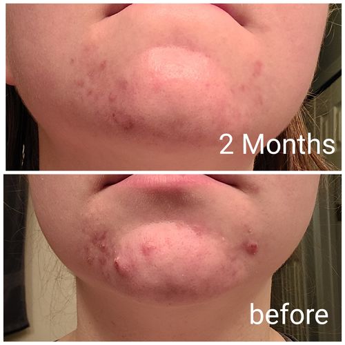 Customer before and after, about 2 months - Kimmi S.