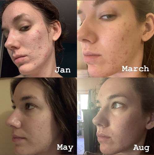 Customer progress photos from January to August - Molly F.