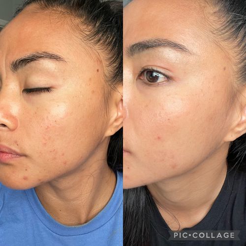 Customer before and after, 2.5 weeks with Extra Strength - Vernice S.